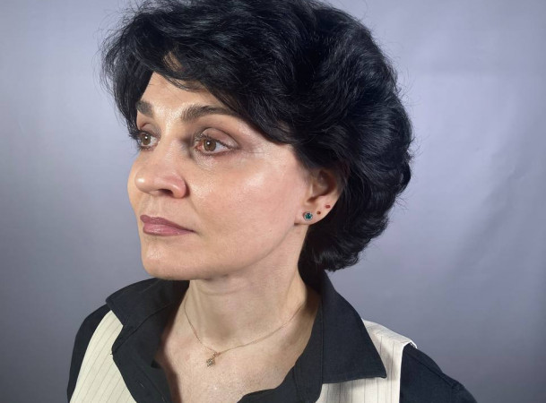 Тотальный лифтинг лица: Эндоскопический лифтинг лба, Эндоскопический лифтинг средней зоны лица, Блефаропластика нижних век, СМАС-лифтинг лица, Платизмопластика - После (threeQuarterView)