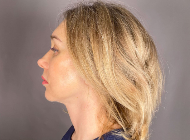 Эндоскопический лифтинг лба, СМАС-лифтинг лица - После (sideView)