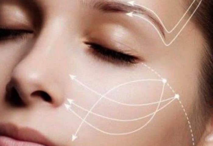 Мезонити для подтяжки лица