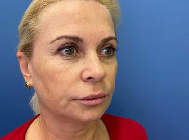 Эндоскопический лифтинга лба, Блефаропластика нижних век, СМАС-лифтинг, Платизмопластика - До (Анфас)