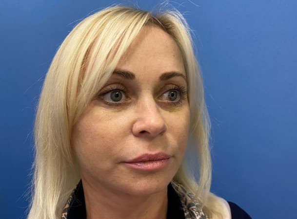 Эндоскопический лифтинга лба, Блефаропластика нижних век, СМАС-лифтинг, Платизмопластика - После (Анфас)