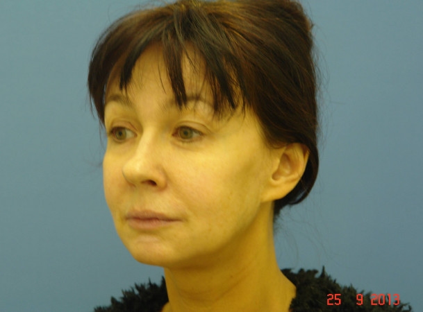 Тотальный лифтинг лица - До (threeQuarterView)