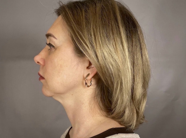 Эндоскопический лифтинг лба, СМАС-лифтинг лица - До (sideView)