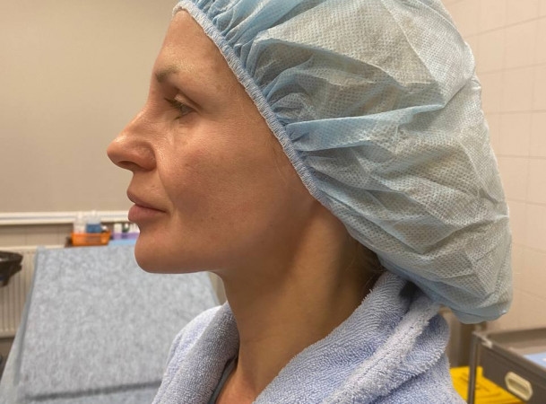 Тотальный лифтинг лица - До (sideView)