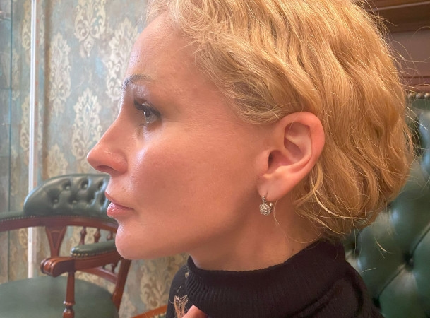 Тотальный лифтинг лица - После (sideView)