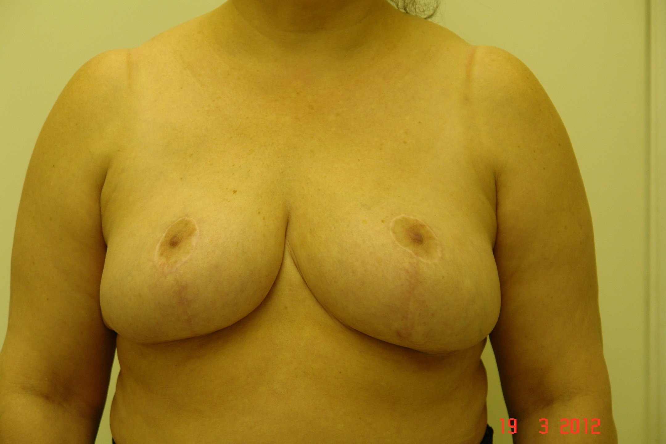 уменьшилась грудь после беременности фото 115